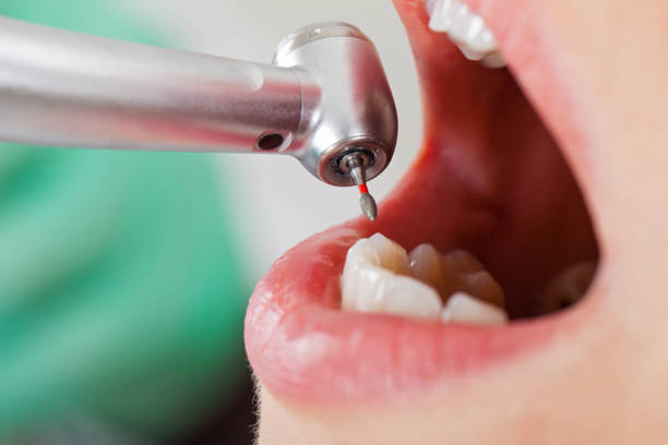 Best Emergency Wisdom Tooth Extraction in Amory, MS